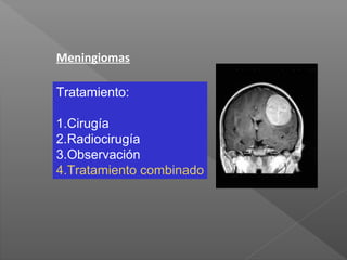 Meningiomas
Tratamiento:
1.Cirugía
2.Radiocirugía
3.Observación
4.Tratamiento combinado
 