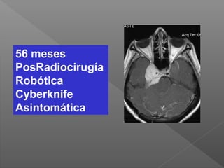 56 meses
PosRadiocirugía
Robótica
Cyberknife
Asintomática
 