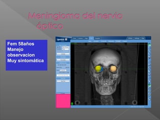Fem 58años
Manejo
observacion
Muy sintomática
 