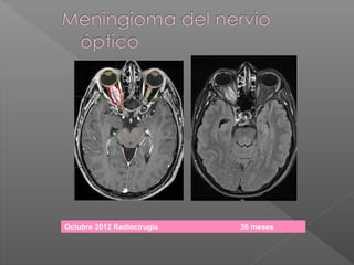 Octubre 2012 Radiocirugía 36 meses
 