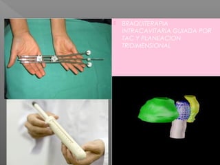  BRAQUITERAPIA
INTRACAVITARIA GUIADA POR
TAC Y PLANEACION
TRIDIMENSIONAL
 