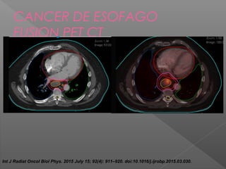 CANCER DE ESOFAGO
FUSION PET CT
Int J Radiat Oncol Biol Phys. 2015 July 15; 92(4): 911–920. doi:10.1016/j.ijrobp.2015.03.030.
 