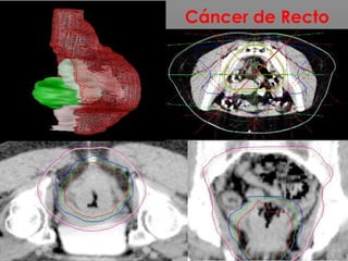 Cáncer de Recto
 