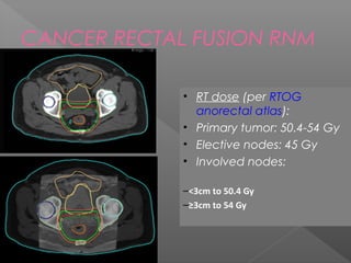 CANCER RECTAL FUSION RNM
• RT dose (per RTOG
anorectal atlas):
• Primary tumor: 50.4-54 Gy
• Elective nodes: 45 Gy
• Involved nodes:
–<3cm to 50.4 Gy
–≥3cm to 54 Gy
 