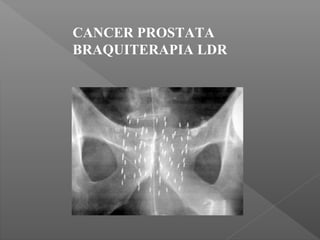 CANCER PROSTATA
BRAQUITERAPIA LDR
 