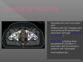 CANCER DE PROSTATA
• Neoadjuvant and concurrent
ADT:
Patients with GS 7 treated with
conventional RT benefit from
short-term ADT (per D'Amico et
al JCO 2011).
• RTOG 0815 is testing dose-
escalated RT (79.2Gy) +/-
short-term ADT (6 months) in
patients with "favorable"
intermediate risk.
 