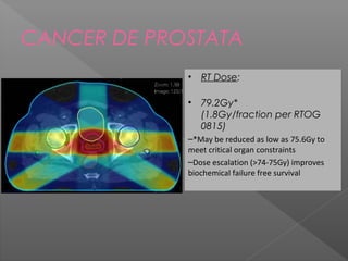 CANCER DE PROSTATA
• RT Dose:
• 79.2Gy*
(1.8Gy/fraction per RTOG
0815)
–*May be reduced as low as 75.6Gy to
meet critical organ constraints
–Dose escalation (>74-75Gy) improves
biochemical failure free survival
 