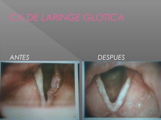 CA DE LARINGE GLOTICA
ANTES DESPUES
 