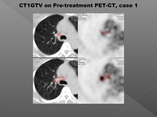 CT1GTV on Pre-treatment PET-CT, case 1
 