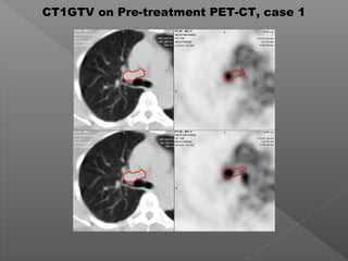 CT1GTV on Pre-treatment PET-CT, case 1
 