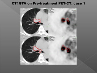 CT1GTV on Pre-treatment PET-CT, case 1
 