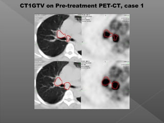 CT1GTV on Pre-treatment PET-CT, case 1
 