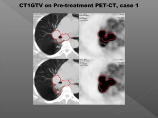 CT1GTV on Pre-treatment PET-CT, case 1
 