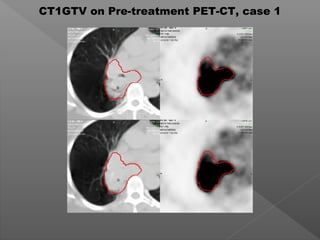 CT1GTV on Pre-treatment PET-CT, case 1
 