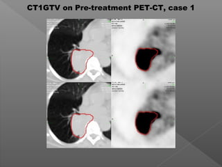 CT1GTV on Pre-treatment PET-CT, case 1
 