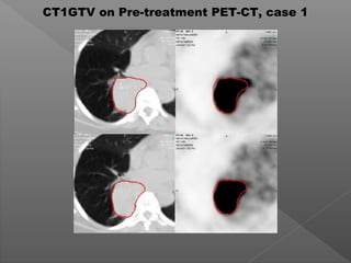 CT1GTV on Pre-treatment PET-CT, case 1
 