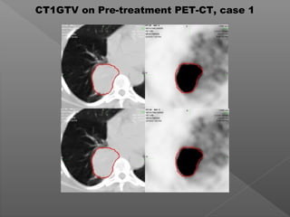 CT1GTV on Pre-treatment PET-CT, case 1
 