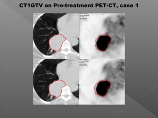 CT1GTV on Pre-treatment PET-CT, case 1
 