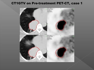 CT1GTV on Pre-treatment PET-CT, case 1
 