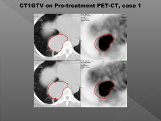 CT1GTV on Pre-treatment PET-CT, case 1
 
