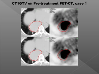 CT1GTV on Pre-treatment PET-CT, case 1
 