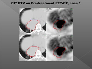 CT1GTV on Pre-treatment PET-CT, case 1
 