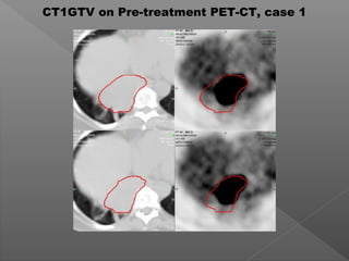 CT1GTV on Pre-treatment PET-CT, case 1
 