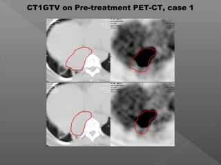 CT1GTV on Pre-treatment PET-CT, case 1
 