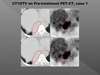 CT1GTV on Pre-treatment PET-CT, case 1
 