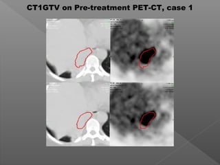 CT1GTV on Pre-treatment PET-CT, case 1
 