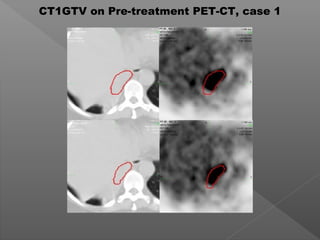 CT1GTV on Pre-treatment PET-CT, case 1
 