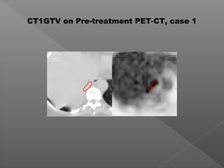 CT1GTV on Pre-treatment PET-CT, case 1
 