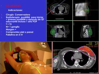 February 15, 2017
 CA. DE MAMA
Indicaciones:
1. Cirugía Conservadora
2. Radioterapia posMRM para iniciar
< 6meses posMRM o después de QT
adyuvante incluso 1 año POP
 T > T3
 N> 1 ganglio
 Margen +
 Compromiso piel o pared
 Paliativa en E IV
 