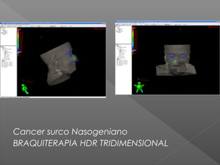 Cancer surco Nasogeniano
BRAQUITERAPIA HDR TRIDIMENSIONAL
 