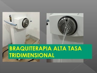 BRAQUITERAPIA ALTA TASA
TRIDIMENSIONAL
 