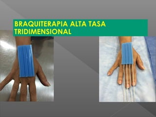 BRAQUITERAPIA ALTA TASA
TRIDIMENSIONAL
 