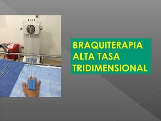 BRAQUITERAPIA
ALTA TASA
TRIDIMENSIONAL
 