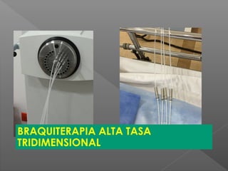 BRAQUITERAPIA ALTA TASA
TRIDIMENSIONAL
 