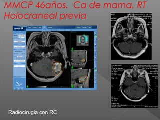 MMCP 46años. Ca de mama, RT
Holocraneal previa
Radiocirugia con RC
 