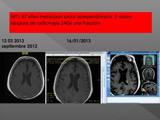 12 03 2013 16/01/2013
septiembre 2012
MTL 67 años metastasis unica subependimaria. 3 meses
despues de radicirugia 24Gy una fraccion-
 