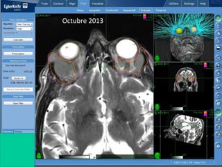FGV linfoma del MantoOctubre 2013
 