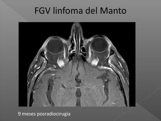 9 meses posradiocirugia
 