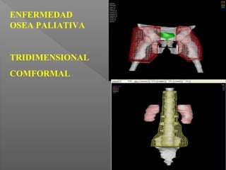 ENFERMEDAD
OSEA PALIATIVA
TRIDIMENSIONAL
COMFORMAL
 