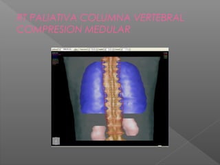 RT PALIATIVA COLUMNA VERTEBRAL
COMPRESION MEDULAR
 
