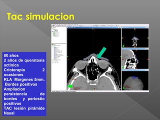 Tac simulacion
80 años
2 años de queratosis
actínica
Crioterapia 2
ocasiones
RLA Margenes 5mm.
Bordes positivos
Ampliacion
persistencia de
bordes y periostio
positivos
TAC lesión pirámide
Nasal
 