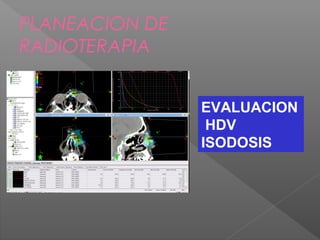 PLANEACION DE
RADIOTERAPIA
EVALUACION
HDV
ISODOSIS
 