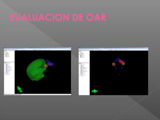 EVALUACION DE OAR
 