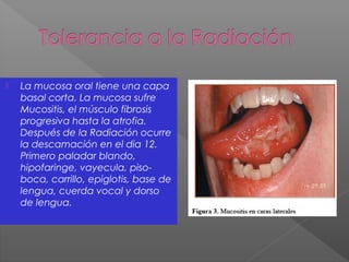  La mucosa oral tiene una capa
basal corta. La mucosa sufre
Mucositis, el músculo fibrosis
progresiva hasta la atrofia.
Después de la Radiación ocurre
la descamación en el dia 12.
Primero paladar blando,
hipofaringe, vayecula, piso-
boca, carrillo, epiglotis, base de
lengua, cuerda vocal y dorso
de lengua.
 