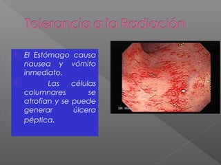  El Estómago causa
nausea y vómito
inmediato.
 Las células
columnares se
atrofian y se puede
generar úlcera
péptica.
 
