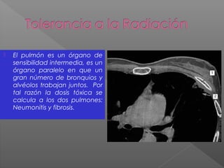  El pulmón es un órgano de
sensibilidad intermedia, es un
órgano paralelo en que un
gran número de bronquios y
alvéolos trabajan juntos. Por
tal razón la dosis tóxica se
calcula a los dos pulmones:
Neumonitis y fibrosis.
 
